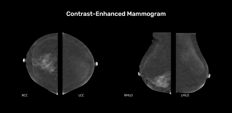 contrast enhanced mammogram