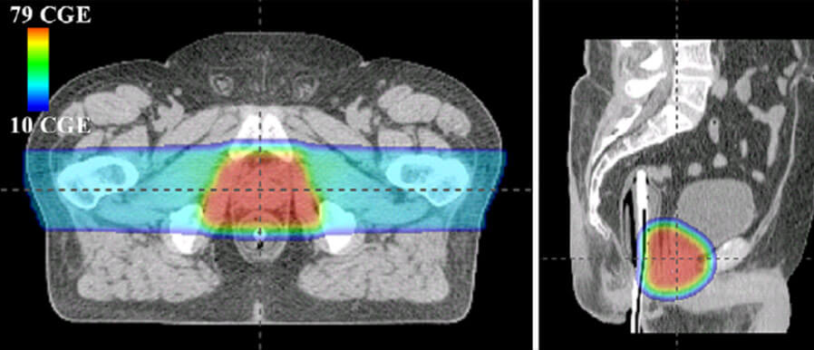 Prostate Imaging: Proton Technology